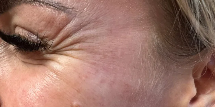 Aplikace botulotoxinu či výplň kyselinou hyaluronovou: eliminace vrásek i zvětšení rtů