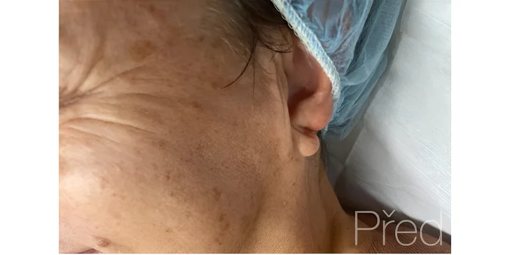 Kosmetické bylinné ošetření pleti Green Peel pro osvěžení i energii