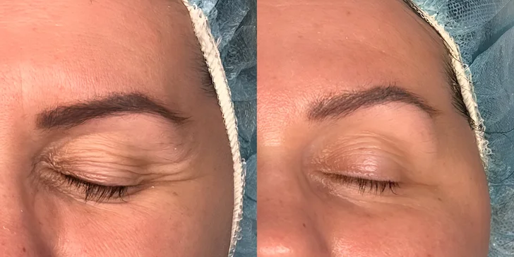 Kosmetické bylinné ošetření pleti Green Peel pro osvěžení i energii