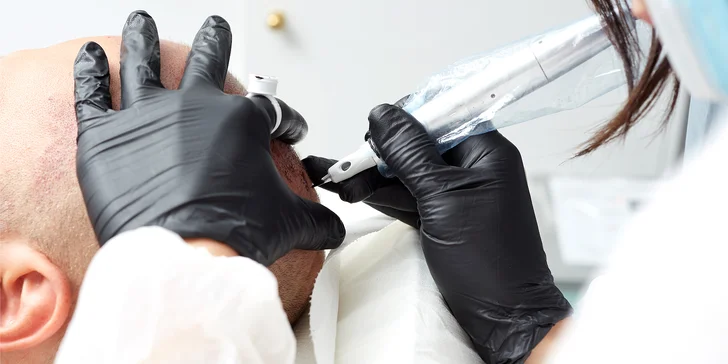 Zahuštění vlasů pomocí mikropigmentace pro muže i ženy: kouty i celá hlava