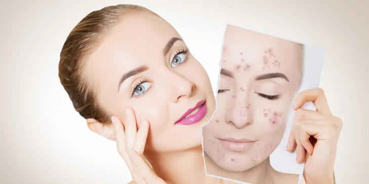 Expresní či hloubkové čištění pro všechny typy pleti vč. aknózní nebo karboxyterapie