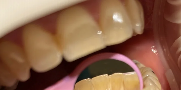 Vstupní vyšetření na dentální hygieně pro děti do 10 let i dospělé nebo domácí bělení