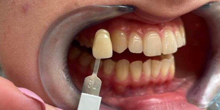 Vstupní vyšetření na dentální hygieně pro děti do 10 let i dospělé