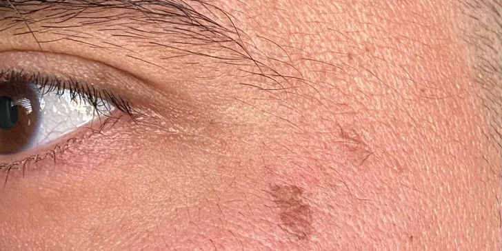 Omlazení pleti: lifting, ultrazvukové či manuální čištění, karboxyterapie, TC Plus peeling nebo mezoterapie