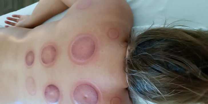 75 minut baňkování zad s masáží šíje nebo i nohou od masérky Adély Kišš