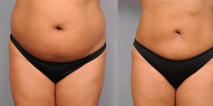 Zeštíhlení přístrojem LipoSonix: 1 až 20 shotů i možnost přístrojové lymfodrenáže či kosmické lodi