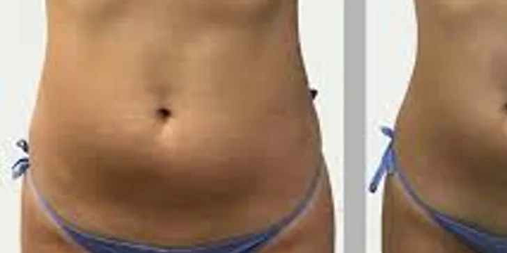 Zeštíhlení přístrojem LipoSonix: 1 až 20 shotů i možnost přístrojové lymfodrenáže či kosmické lodi
