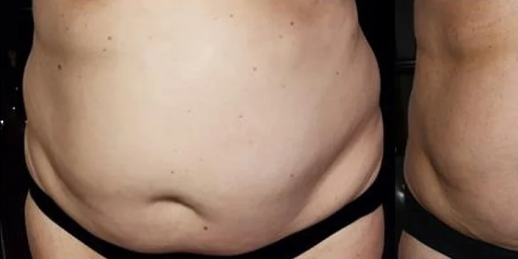 Zeštíhlení přístrojem LipoSonix: 1 až 20 shotů i možnost přístrojové lymfodrenáže či kosmické lodi