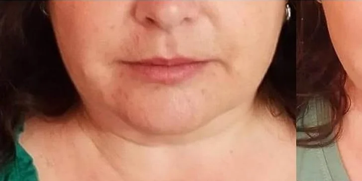 Zeštíhlení přístrojem LipoSonix: 1 až 20 shotů i možnost přístrojové lymfodrenáže či kosmické lodi