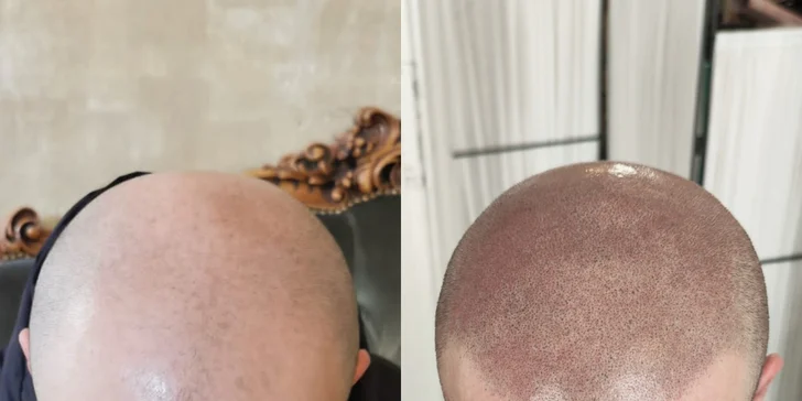 Z pleše strniště: tetování vlasů mikropigmentací