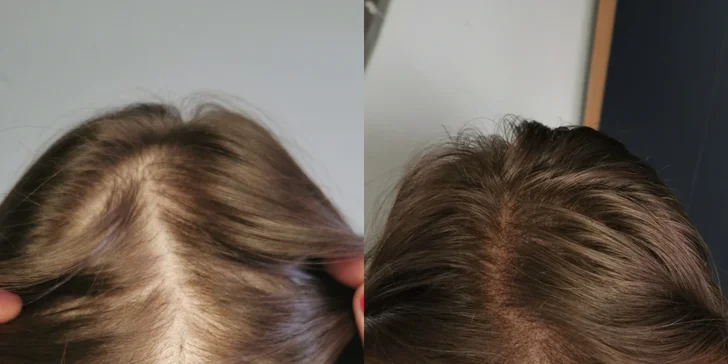 Z pleše strniště: tetování vlasů mikropigmentací