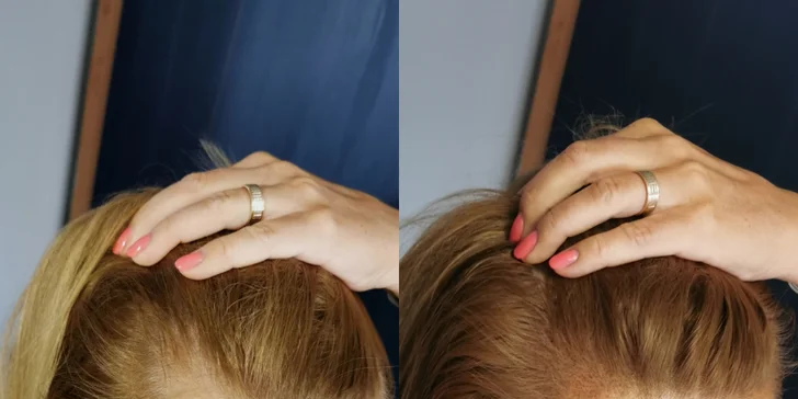 Z pleše strniště: tetování vlasů mikropigmentací
