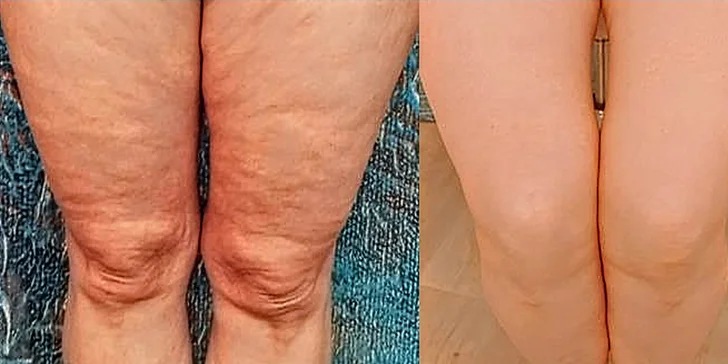 Zeštíhlení přístrojem LipoSonix: 1 až 20 shotů i možnost přístrojové lymfodrenáže či kosmické lodi