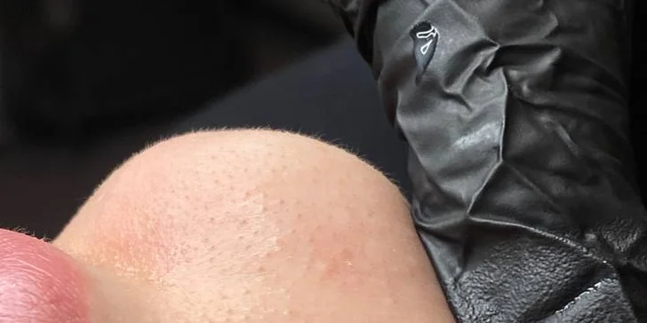 Omlazení pleti: lifting, ultrazvukové či manuální čištění, karboxyterapie, TC Plus peeling nebo mezoterapie