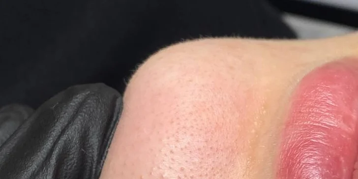 Omlazení pleti: lifting, ultrazvukové či manuální čištění, karboxyterapie, TC Plus peeling nebo mezoterapie