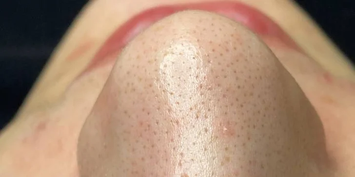 Omlazení pleti: lifting, ultrazvukové či manuální čištění, karboxyterapie, TC Plus peeling nebo mezoterapie