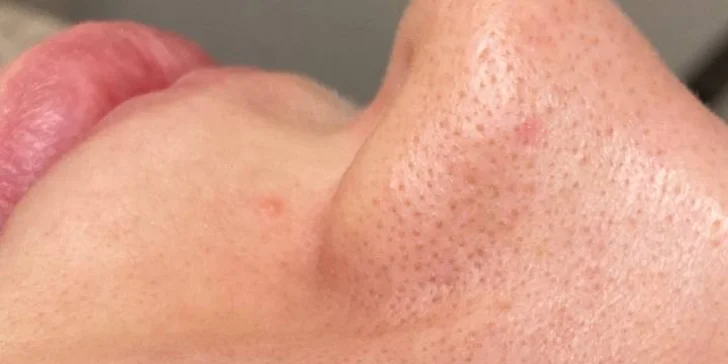 Omlazení pleti: lifting, ultrazvukové či manuální čištění, karboxyterapie, TC Plus peeling nebo mezoterapie