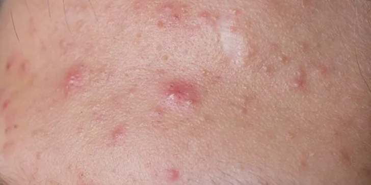 Kosmetické ošetření vč. diagnostiky a edukace v péči o aknózní pleť
