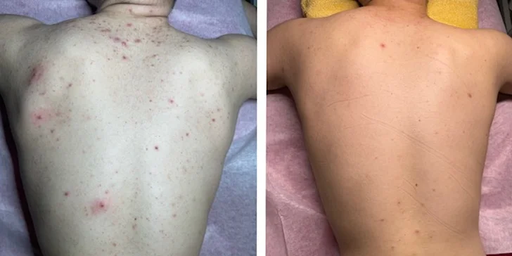 Kosmetické ošetření pro muže: pro aknózní záda či péče pro všechny typy pleti