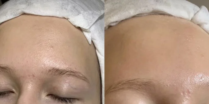 Péče pro všechny typy pleti: chemický peeling, masáž, karboxyterapie i mikrojehličkování