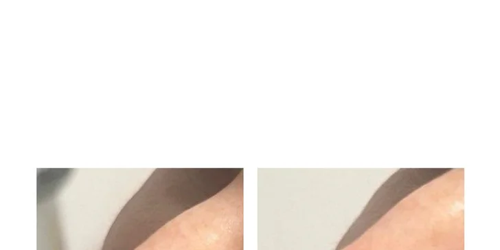 Tekutá rhinoplastika
