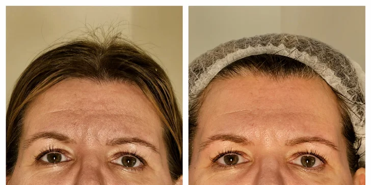 Laserová rejuvenace (omlazení) přístrojem Soprano ICE Platinum: 1 nebo 3 ošetření