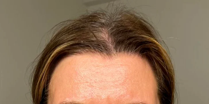 Laserová rejuvenace (omlazení) přístrojem Soprano ICE Platinum: 1 nebo 3 ošetření