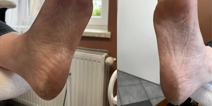 Přístrojová pedikúra: ošetření pokožky i nehtů s možností gel laku
