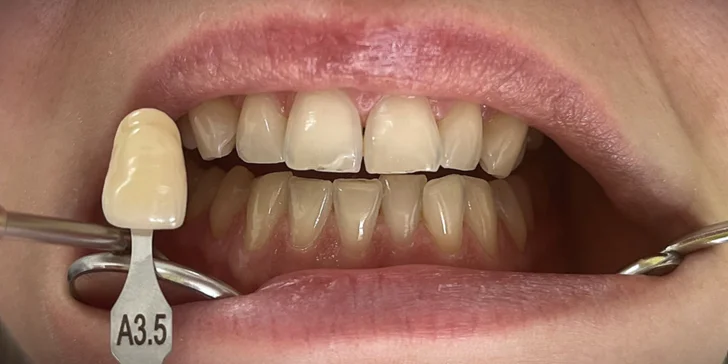 Dentální hygiena vč. pískování zubů nebo set na domácí bělení zubů