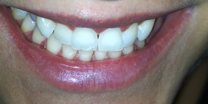 Dentální hygiena vč. pískování zubů nebo set na domácí bělení zubů