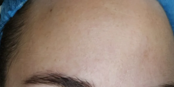 Kosmetická péče proti vráskám, akné i pigmentovým skvrnám: nanoneedling i biomicroneedling