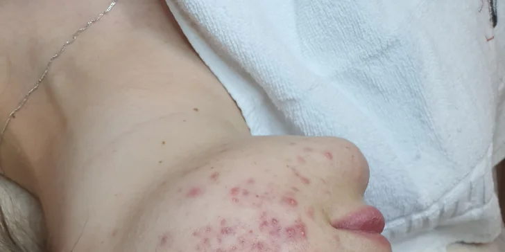 Kosmetické ošetření Lasocare®: anti-aging omlazení pleti nebo péče proti akné