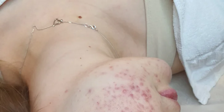 Kosmetické ošetření Lasocare®: anti-aging omlazení pleti nebo péče proti akné