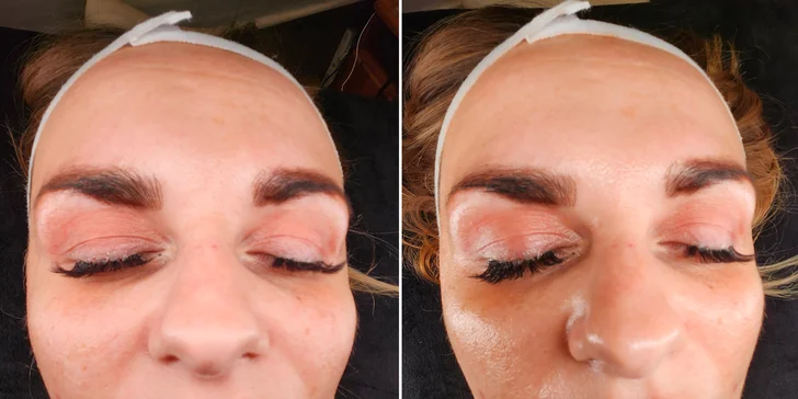 Kosmetická péče proti vráskám, akné i pigmentovým skvrnám: nanoneedling i biomicroneedling