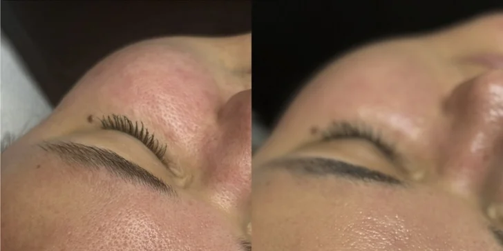 Kosmetické ošetření pro aknózní pleť s čištěním ultrazvukovou špachtlí