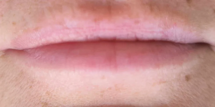 Krásné rty či pleť bez vrásek: jedno nebo dvě ošetření pomocí hyaluron pen
