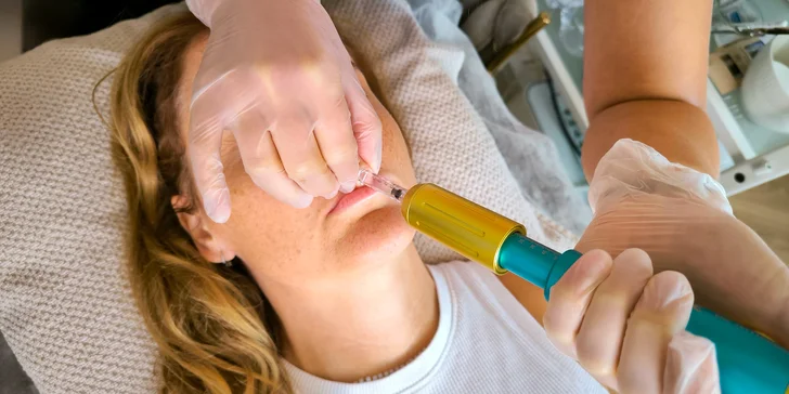 Krásné rty či pleť bez vrásek: jedno nebo dvě ošetření pomocí hyaluron pen