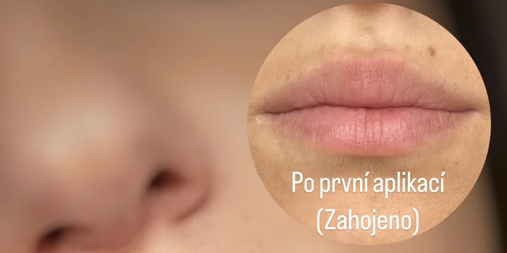 Pro plnější rty: aplikace 1 ml kyseliny hyaluronové pomocí hyaluron pen