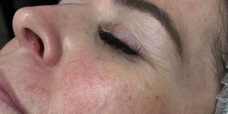 Hloubkové čištění pleti pomocí karbonového peelingu: 1 nebo 3 ošetření