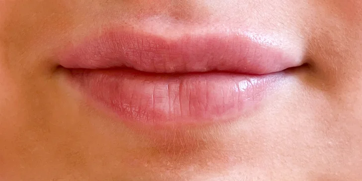 Pro plnější rty: aplikace 1 ml kyseliny hyaluronové pomocí hyaluron pen