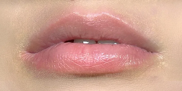Pro plnější rty: aplikace 1 ml kyseliny hyaluronové pomocí hyaluron pen