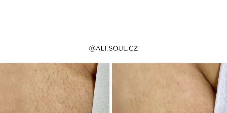 Laserová epilace pro ženy partie dle výběru: podpaží, nohy i intimní partie