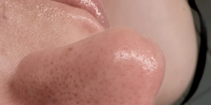Kompletní péče o pleť: hloubkové čištění, peeling, masáž i mikrojehličkování