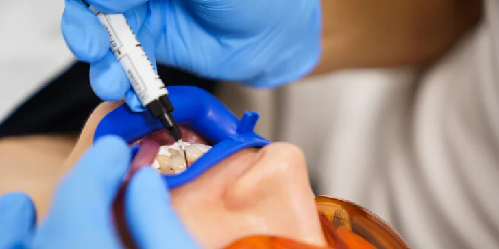 Ordinační bělení zubů LED lampou Philips Zoom s možností dentální hygieny