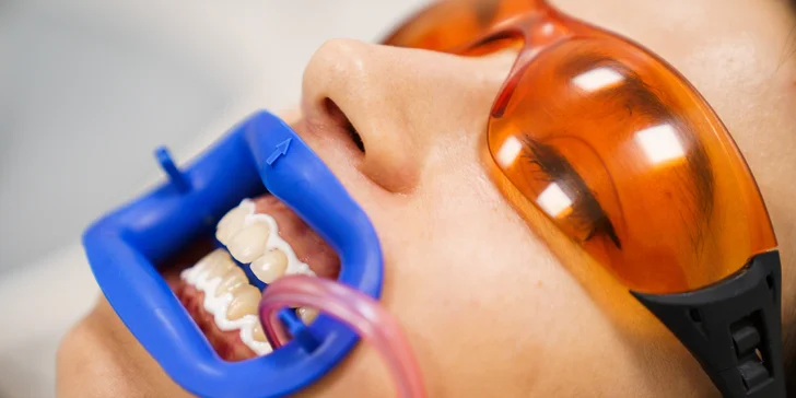 Ordinační bělení zubů LED lampou Philips Zoom s možností dentální hygieny