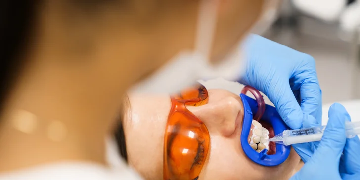 Ordinační bělení zubů LED lampou Philips Zoom s možností dentální hygieny