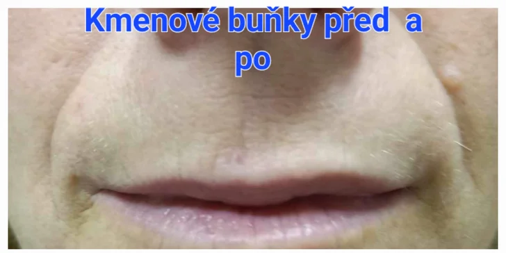 Estetické ošetření dle výběru: kmenové buňky, biorevitalizace i výplň. kys. hyaluronovou