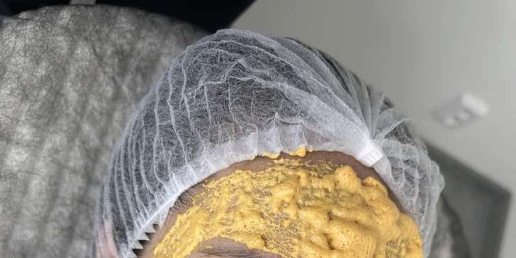 Kosmetické ošetření: ultrazvukové čistění, karboxyterapie, peeling i mikrojehličkování