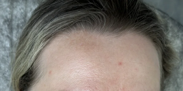 Kosmetické ošetření: ultrazvukové čistění, karboxyterapie, peeling i mikrojehličkování