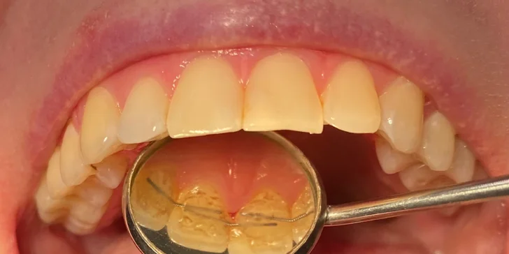 Okouzlete zářivým úsměvem: dentální hygiena ve Stodůlkách pro děti i dospělé, vč. možnosti bělení